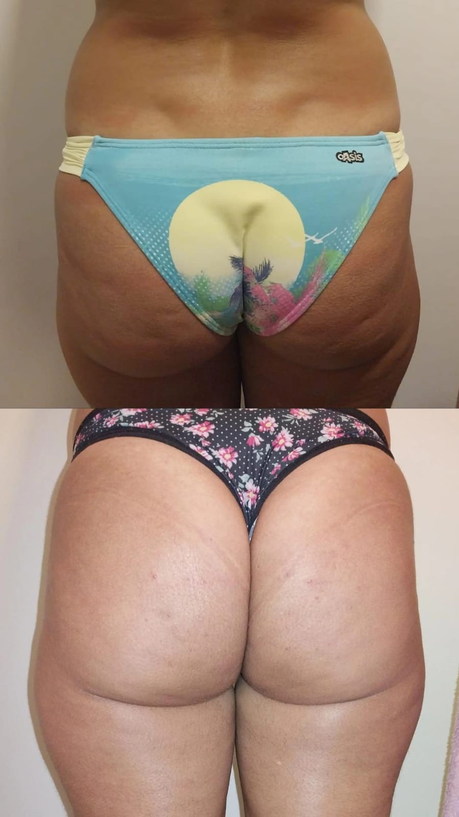 Tratamento anticelulite